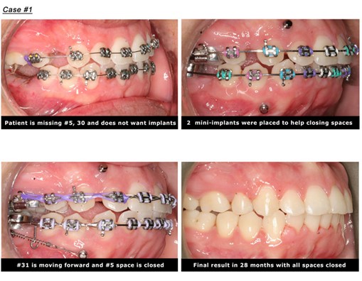 close space for missing tooth case 1 with mini implants temporary anchorage device TADS